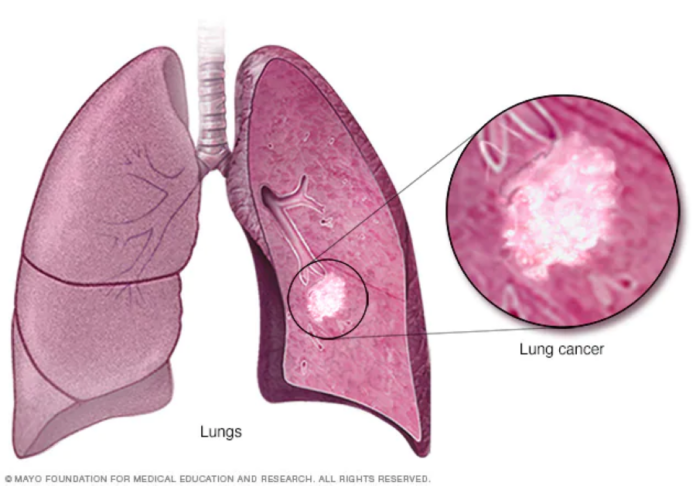 Addressing the Lung Cancer Crisis in Nigeria and Sub-Saharan Africa: Insights from Prof. Kelechi Okonta's Landmark Lecture