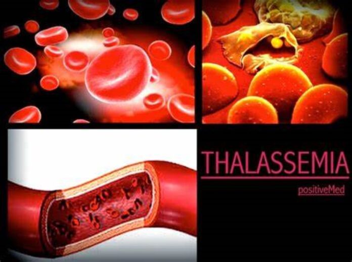Thalassemia in Sub-Saharan Africa: Epidemiology, Diagnosis, and Urgent Public Health Solutions in Malaria-Endemic Regions